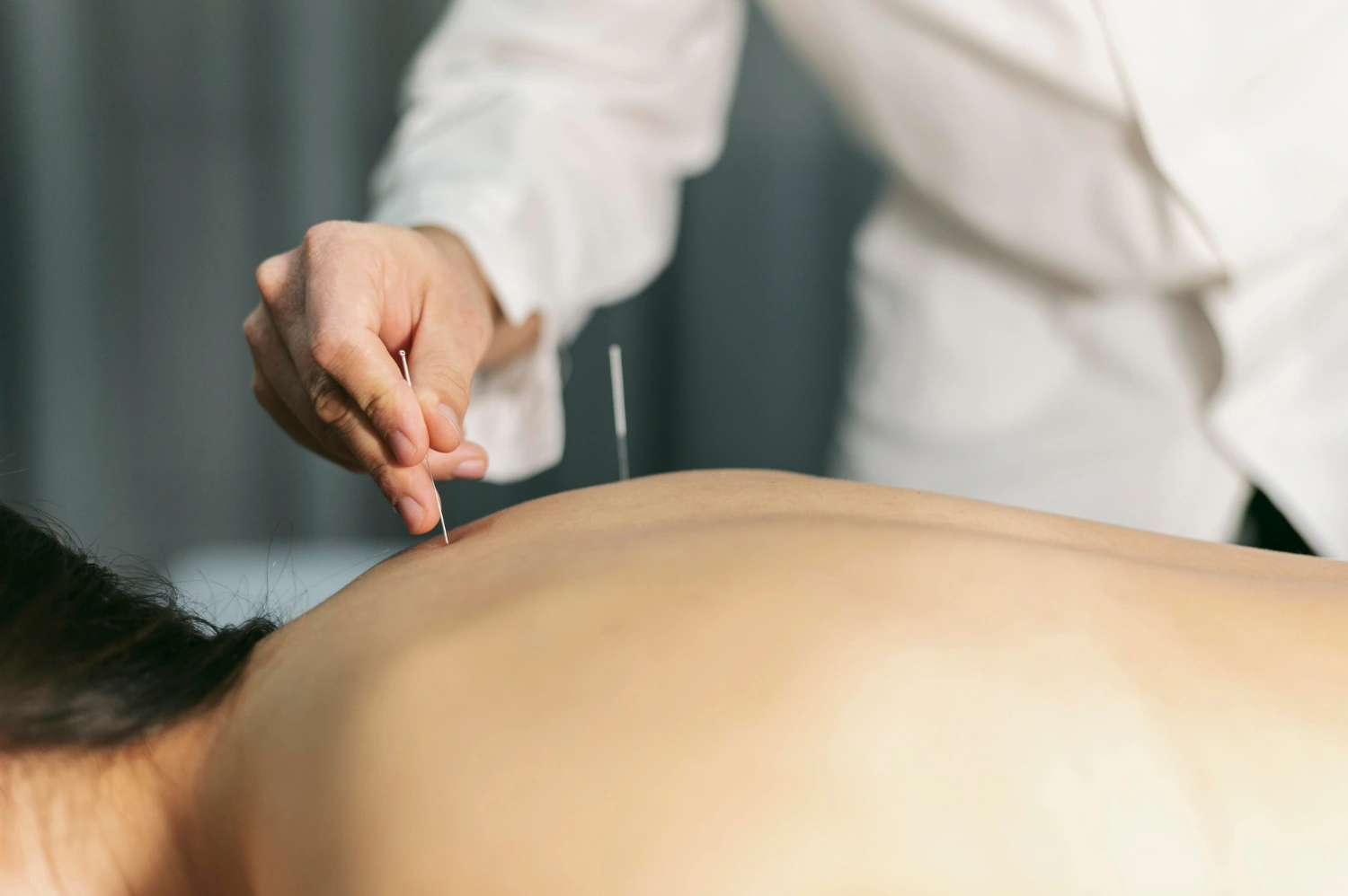 Acupuncture treatment on a person's back at Premier Wellness Orewa