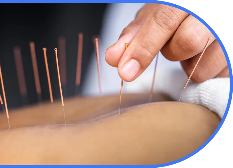 Acupuncture treatment in Auckland at Premier Wellness Orewa and North Shore