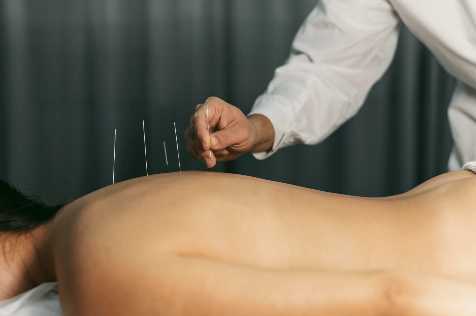 Acupuncture treatment at Premier Wellness Auckland