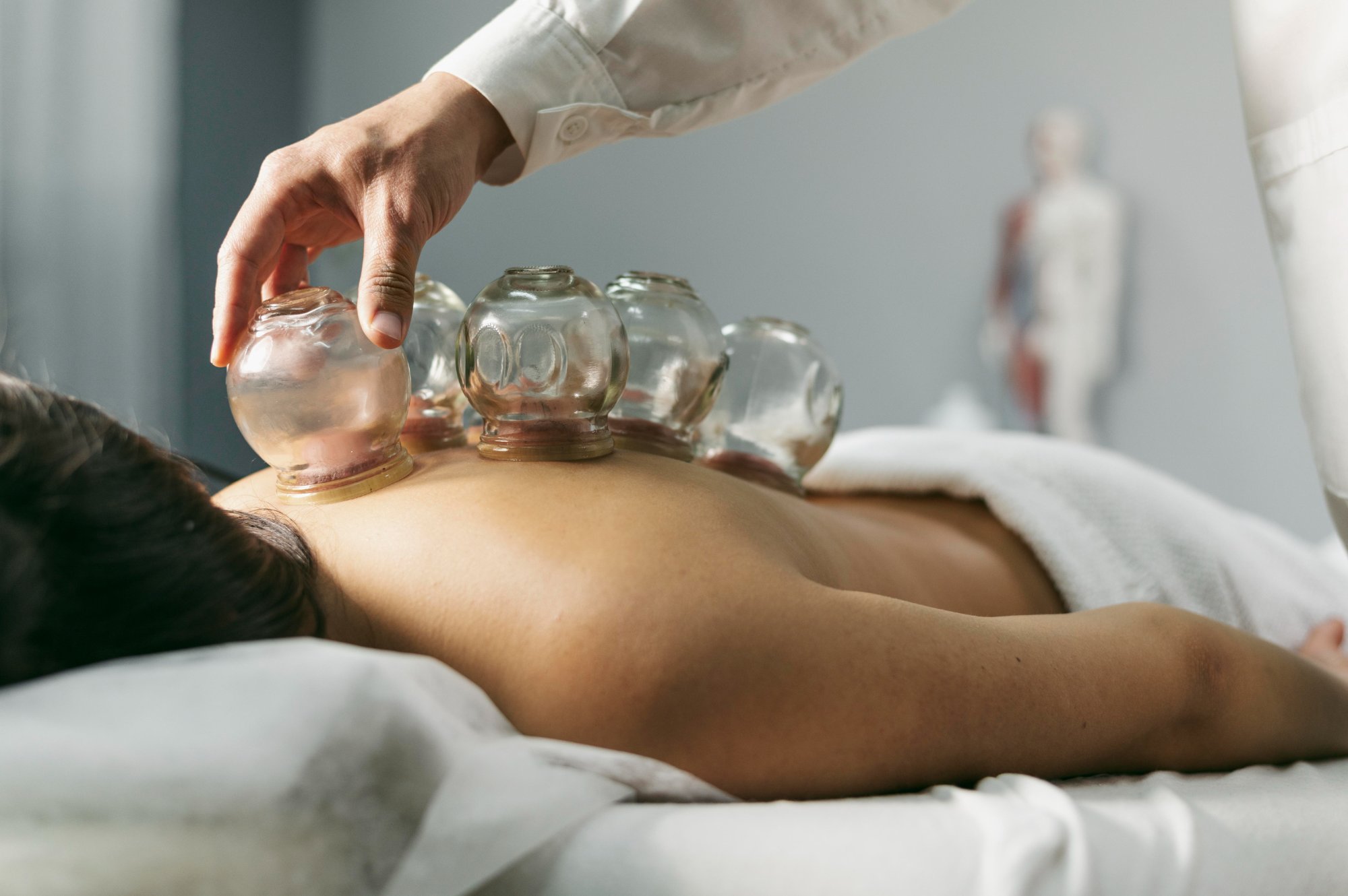 Glass suction cups being placed on a patient's back — cupping therapy and physical therapy at Premier Wellness