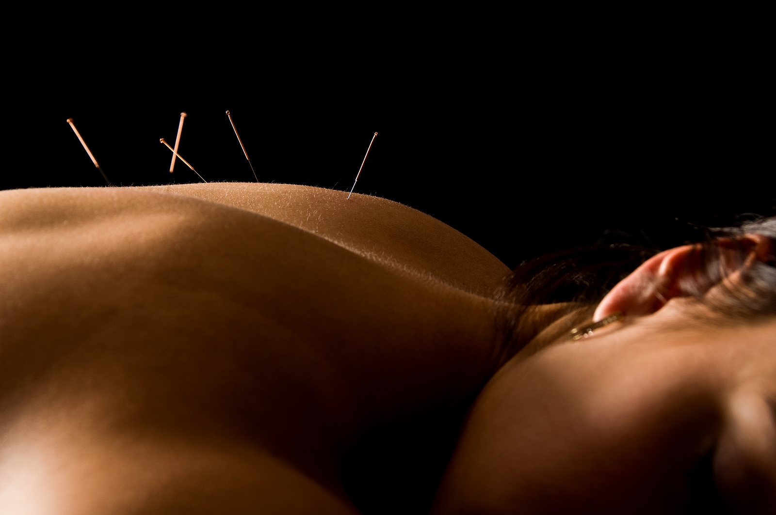 Dry needling Auckland &mdash; a single fine needle placed in the muscle of the upper back