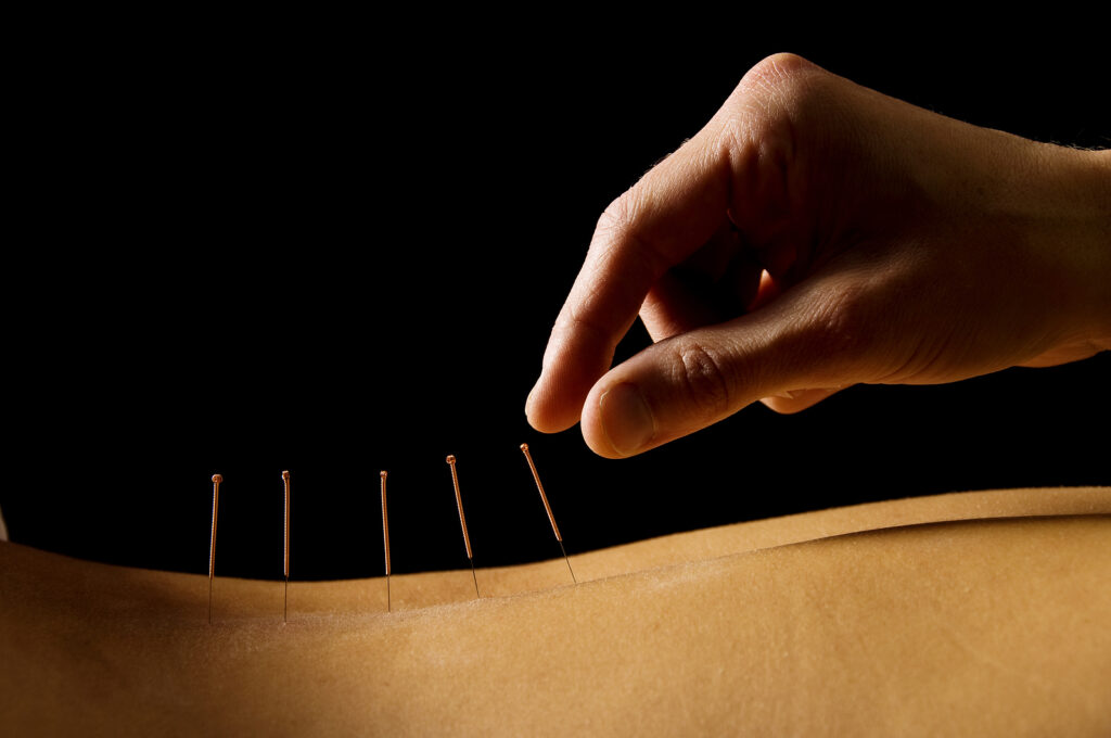 Home Page Premier Wellness 4 Acupuncture treatment at Premier Wellness North Shore