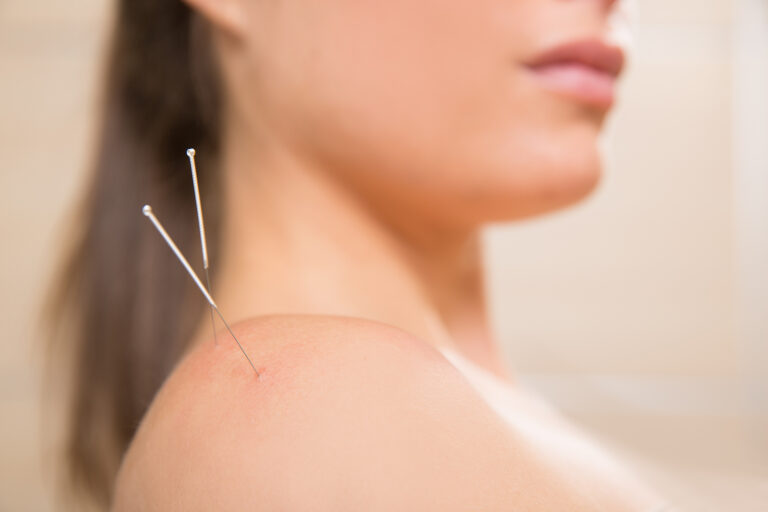 Acupuncture needle used in dry needling therapy on the shoulder
