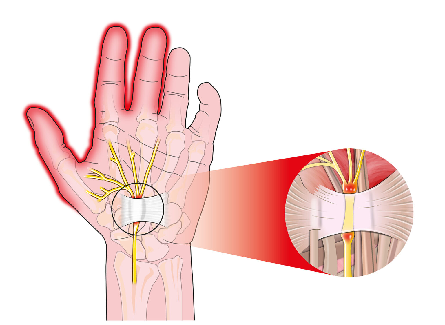 Work Injury Auckland 2 Diagram of the hand showing the median nerve compressed under the transverse carpal ligament