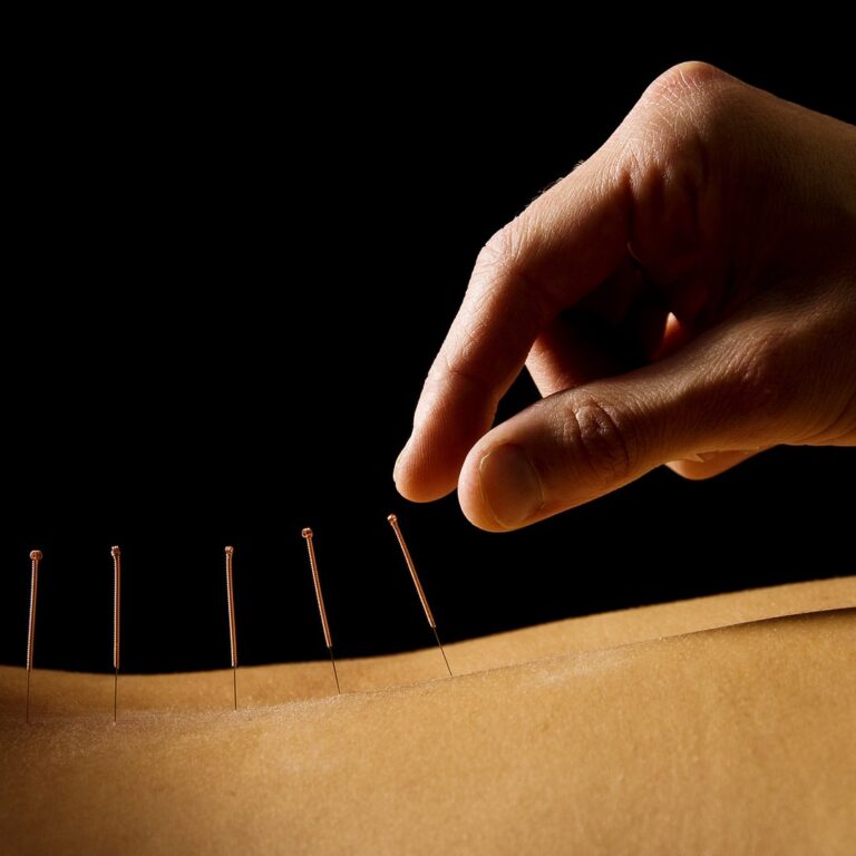 Acupuncture needles placed along a patient’s back