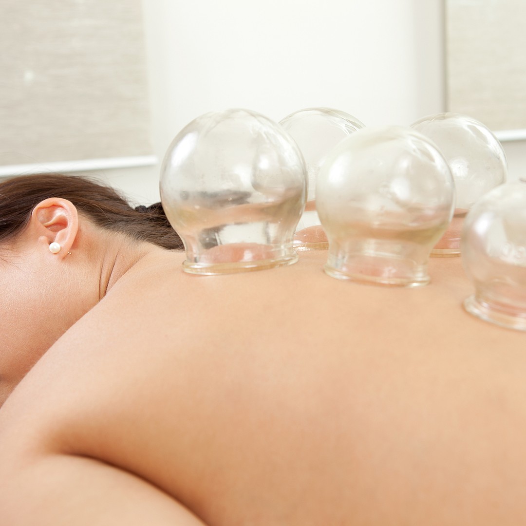 Chronic Fatigue Auckland 2 Glass cups placed along a patient’s upper back during a cupping treatment