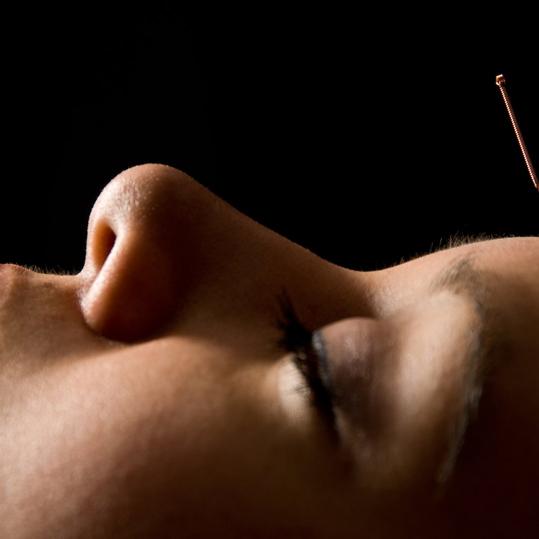 Cosmetic acupuncture Auckland &mdash; facial acupuncture treatment at Premier Wellness Orewa, Hibiscus Coast