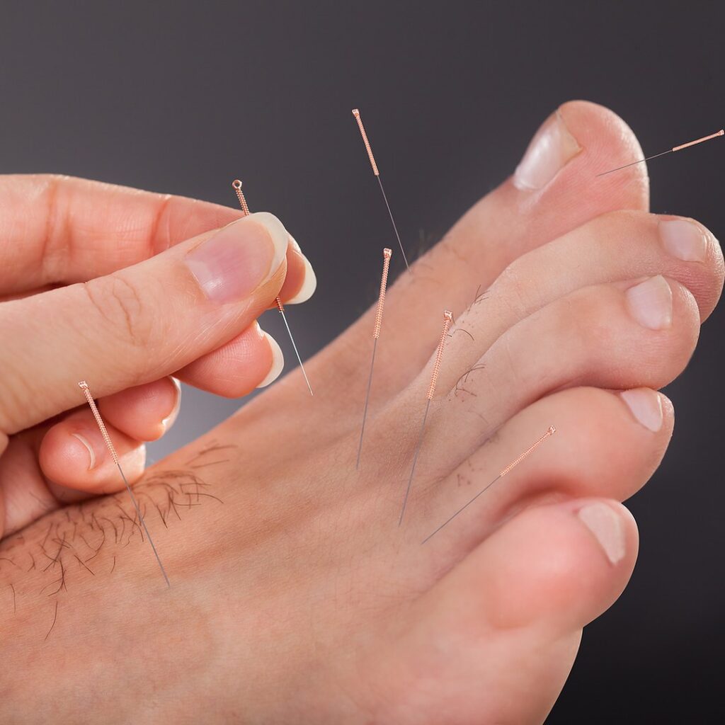 Acupuncturist placing fine needles in points on the foot