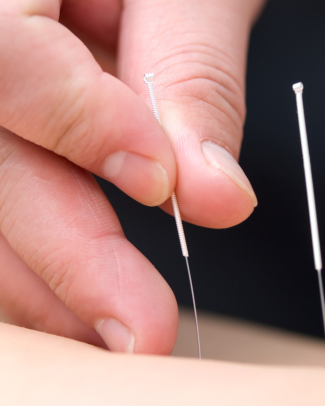 Acupuncturist holding a single fine needle before a cosmetic acupuncture Auckland treatment at Premier Wellness Orewa