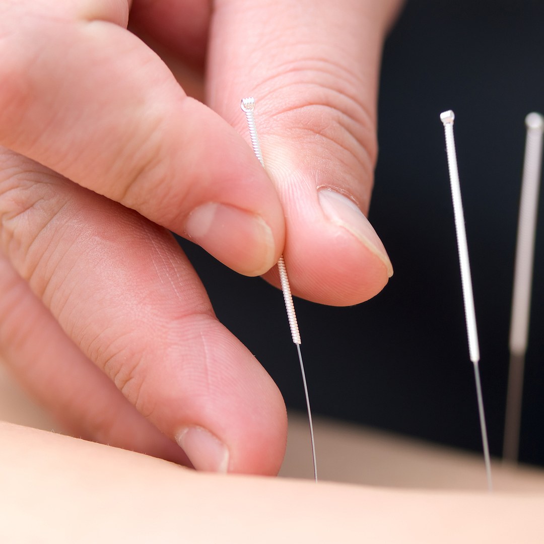 Acupuncture Auckland 1 Acupuncture Auckland — acupuncturist holding a single sterile needle before inserting it