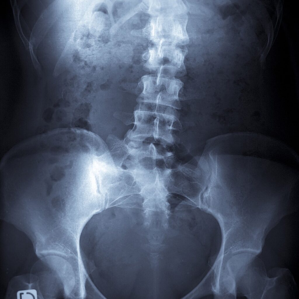 Back Pain North Shore &mdash; x-ray of the lumbar spine and pelvis
